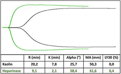 Hemostasis in neonatal ECMO